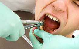 Vì sao phải nhổ răng khôn?