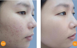 Dùng vitamin C chuẩn cách này, làn da trắng đẹp, sạch mụn cực nhanh