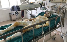 Cô gái bị người yêu tẩm xăng thiêu sống ở Vĩnh Phúc đã qua đời
