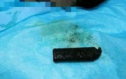 Nuốt bật lửa vào bụng, 20 năm sau mới lấy ra