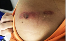 Ngủ trong mùng, bé gái 11 tuổi ở TP.HCM bị con rết dài 30 cm chui vào cắn trọng thương