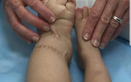 4 em bé tại Hà Nội mắc chứng bệnh phù chân voi hiếm gặp