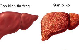 Xơ gan có thể dẫn đến ung thư gan: Đây là 4 nguyên tắc quan trọng giúp phòng ngừa hiệu quả