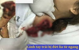 Bé gái vĩnh viễn mất cánh tay trái khi té ngã vào máy cưa gỗ