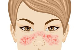 12 dấu hiệu cảnh báo bệnh lupus ban đỏ