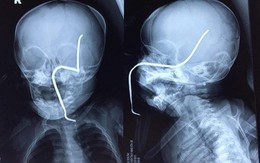 Hà Nội: Tai nạn hi hữu, bé gái 8 tháng bị thanh sắt rỉ xuyên thẳng hộp sọ