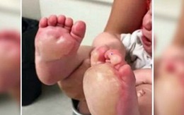 Phát hiện chân con có vết phồng rộp lớn, bà mẹ nghi ngờ nên báo cảnh sát và phát hiện ra sự thật rùng rợn về người trông trẻ