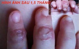 Cách cấp cứu khi bị đứt lìa chân, tay