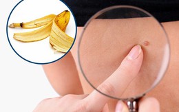 8 phương pháp cực đơn giản mà lại hiệu quả giúp chị em loại bỏ mụn thịt trên da