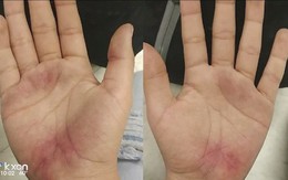 Con đi học về với đôi bàn tay trầy trụa, mẹ báo nhà trường và cảnh sát vào cuộc điều tra ngay lập tức