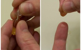 Mẹo trị sẹo mụn an toàn mà không hề tốn kém, không chỉ vết thâm biến mất, da mặt cũng mịn màng sáng sủa hẳn ra