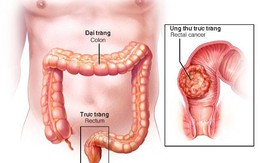 Ung thư đường tiêu hóa, họa từ những món ăn quen thuộc