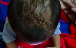 Bé trai 3 tuổi nghi bị mẹ ruột và cha dượng bạo hành dã man