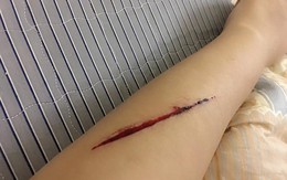 Hà Nội: Xôn xao thông tin cảnh báo của cô gái trẻ bị tên cướp rạch tay, giật túi xách