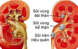 Từ vụ bé 5 tuổi mắc sỏi thận, chuyên gia chỉ rõ cần tránh xa những thói quen này