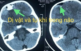 Nghịch súng bắn đạn bi, bé trai bị chấn thương sọ não