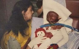 2 tuổi đã bị bỏng toàn thân vì máy giặt phát nổ, hơn 20 năm sau ai cũng bất ngờ khi nhìn thấy dáng vẻ của người phụ nữ ấy