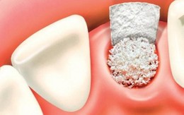 Chữa trị viêm tủy răng thế nào?