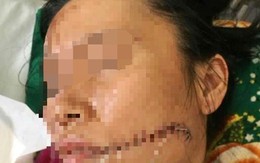 Rạch mặt người tình rồi tưới xăng thiêu sống để 'chết chung'