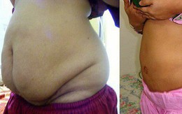 Câu hỏi lớn nhất khi hút mỡ bụng: Hút xong có bị béo lại hay không? Đáp án cực kỳ bất ngờ đấy!