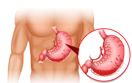 Điều trị viêm hang vị sung huyết