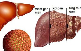 Căn bệnh nguy hiểm có thể dẫn đến ung thư gan: Tốn 400 triệu vẫn không chữa được