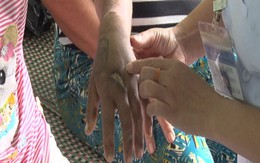 Đi làm thuê, bị chủ đánh đập biến dạng đến mẹ đẻ nhận không ra