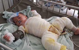 Xót xa cậu bé 3 tuổi khổ sở vì di chứng bỏng nước sôi kinh hoàng