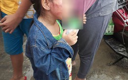 TP HCM: Bé gái 5 tuổi nghi bị bảo mẫu tát liên tục đến sưng mặt, dọa lấy kéo cắt lưỡi nếu nói cho gia đình biết