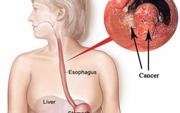 Âm thầm rước "án tử" vào đường tiêu hóa vì thói quen gần như ai cũng mắc phải