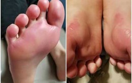 Hốt hoảng khi con kêu “chân như bốc cháy”, đi khám mới biết là do thứ con mặc trên người