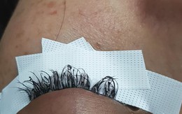 Cô gái đau đớn lĩnh hậu quả với đôi mắt sưng húp, rụng sạch lông mi vì nối mi bằng keo dán sắt