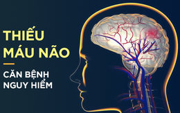 Dấu hiệu điển hình của bệnh thiếu máu não: Hãy cảnh giác sớm để tránh bị đột quỵ bất ngờ