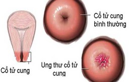 3 cách phát hiện ung thư cổ tử cung sớm nhất: Mọi phụ nữ cần biết đừng để quá muộn