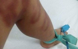 Bé trai 4 tuổi nguy kịch do người tình của mẹ bạo hành dã man