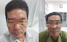 Hai nam bệnh nhân phát hiện ung thư từ lần đi đốt laze thẩm mỹ nốt ruồi lạ trên mặt