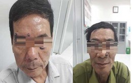 Đi đốt nốt ruồi, 2 người đàn ông bất ngờ phát hiện ung thư