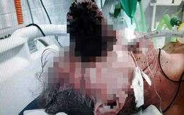 Trượt ngã trong nhà vệ sinh, người đàn ông bị cái bàn chải đâm vào mặt dẫn đến tử vong
