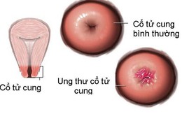 Những nguy hiểm đáng sợ nếu thường xuyên "yêu trong ngày đèn đỏ"