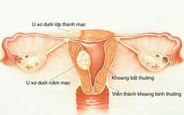 Bác sĩ BV Phụ Sản chỉ rõ nguyên nhân sẩy thai liên tiếp các mẹ cần chú ý