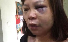 Nữ hộ lý bệnh viện ở Quảng Ninh bị chồng bạo hành dã man