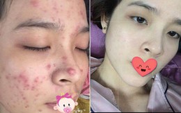 Từng chịu cảnh mụn do kem trộn, cô nàng này đã lấy lại làn da mịn màng nhờ 6 sản phẩm này