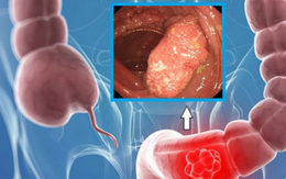 Dấu hiệu cảnh báo bị ung thư đại trực tràng, cần phải ngăn ngừa càng sớm càng tốt