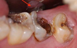 Chuyện gì sẽ xảy ra nếu bạn có một chiếc răng sâu và không chịu chữa trị ngay?