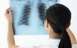 Những điều cần biết về bệnh lao màng phổi