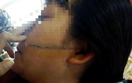 Nữ sinh lớp 11 bị đâm rách mặt vì mâu thuẫn ở chợ