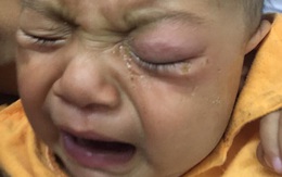 Bé 7 tháng tuổi hỏng mắt vì mẹ nhỏ sữa mẹ chữa đỏ mắt