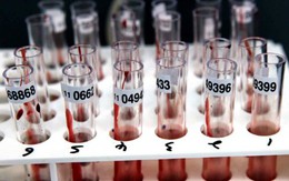 Một xét nghiệm máu có thể phát hiện tám bệnh ung thư