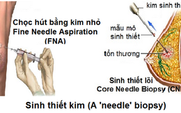 Phát hiện sớm ung thư cần làm các xét nghiệm nào?