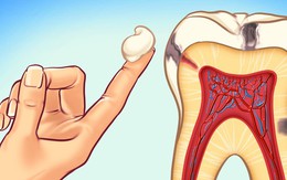 Nha sĩ tiết lộ 10 cách đơn giản để ngăn ngừa sâu răng